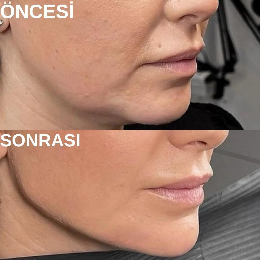 V-Shape Yüz Şekillendirici